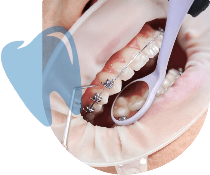 get Orthodontic Braces