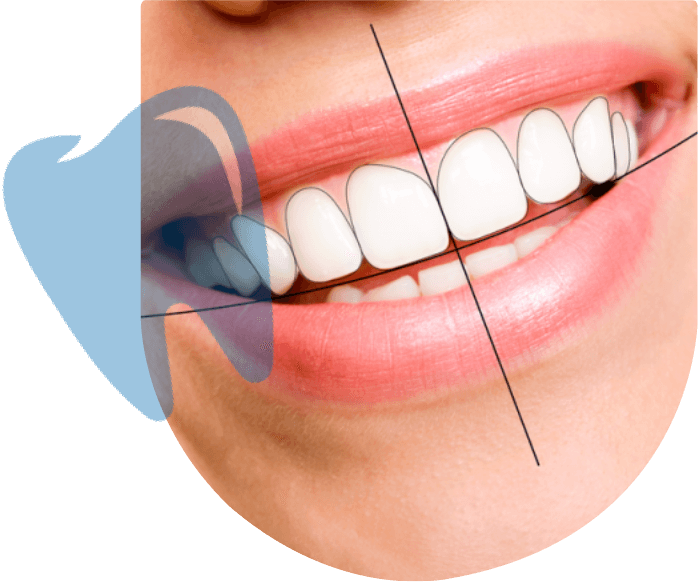 get smile design