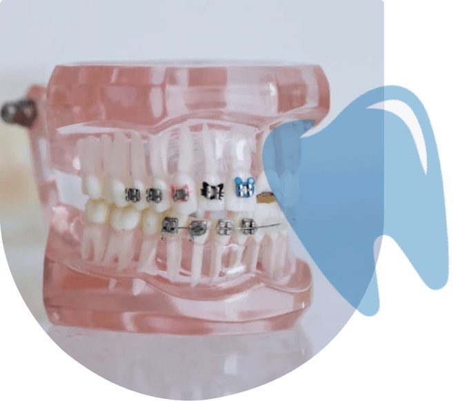 what Orthodontic Braces